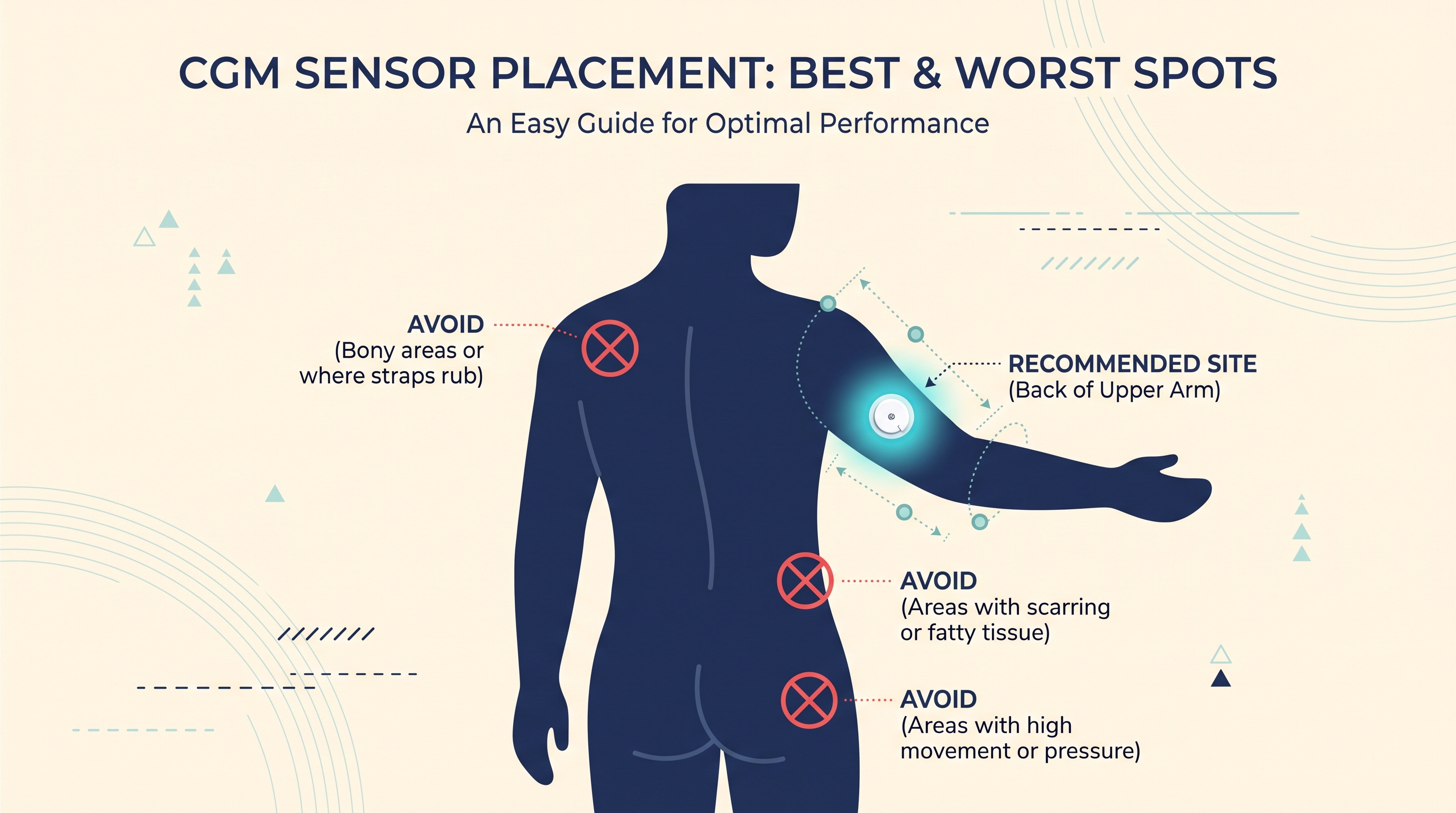 CGM Sensor Placement: Best and Worst Spots on Your Body